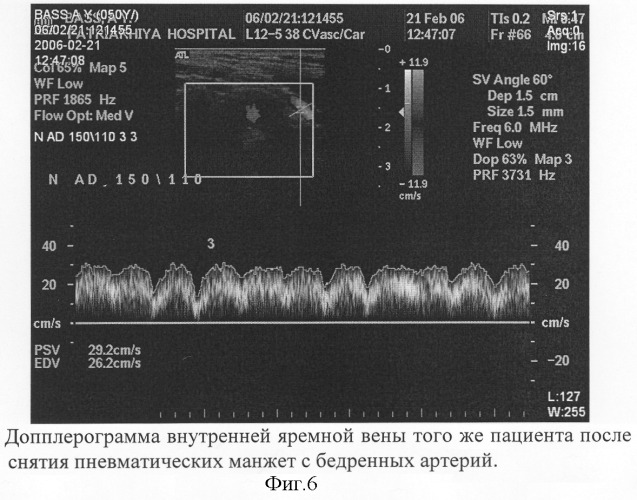 Способ диагностики ауторегуляции сосудов головного мозга (патент 2311133)