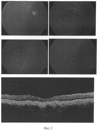 Способ определения показаний к фотодинамической терапии хронической центральной серозной хориоретинопатии (патент 2495620)