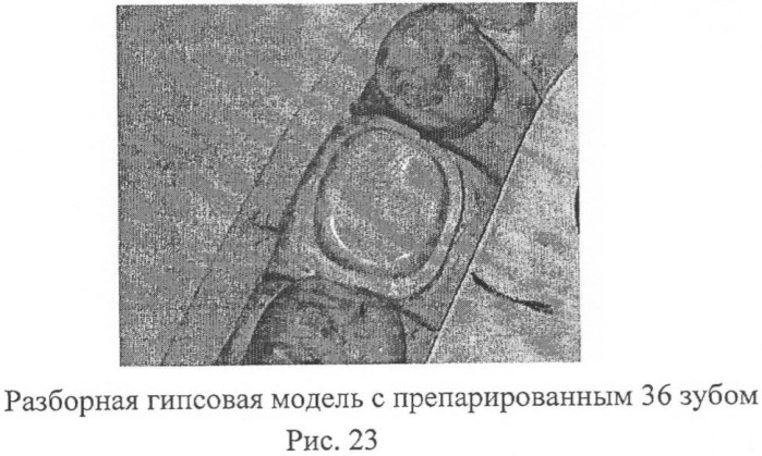 Способ контроля препарирования окклюзионной поверхности зубов при ортопедическом лечении несъемными протезами (патент 2396921)