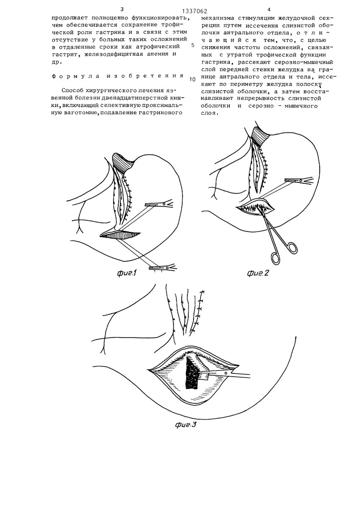 Способ хирургического лечения язвенной болезни двенадцатиперстной кишки (патент 1337062)