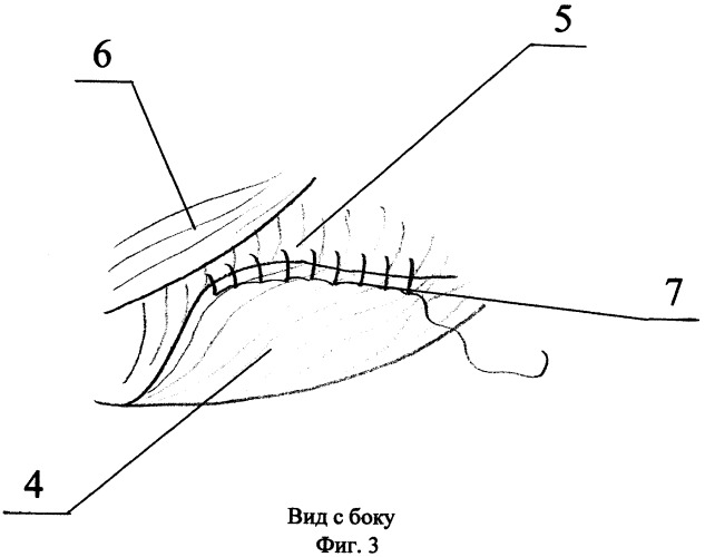 Способ миопластики после радикальных органосохраняющих операций на молочной железе (патент 2436521)