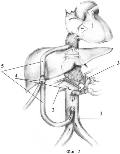 Способ временного шунтирования магистрального кровообращения при обширной резекции нижней полой вены и ее висцеральных ветвей (патент 2329773)
