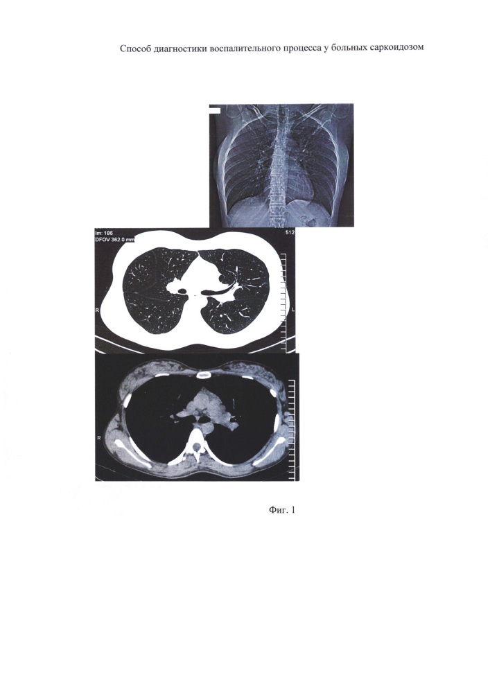Способ диагностики воспалительного процесса в легких и во внутригрудных лимфатических узлах у больных саркоидозом (патент 2638447)