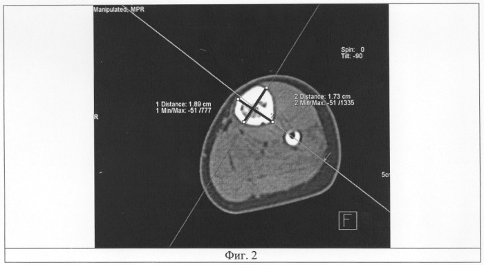 Способ исследования плотности дистракционного регенерата при компьютерной томографии (патент 2289314)