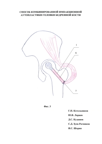 Способ комбинированной импакционной аутопластики головки бедренной кости (патент 2583577)