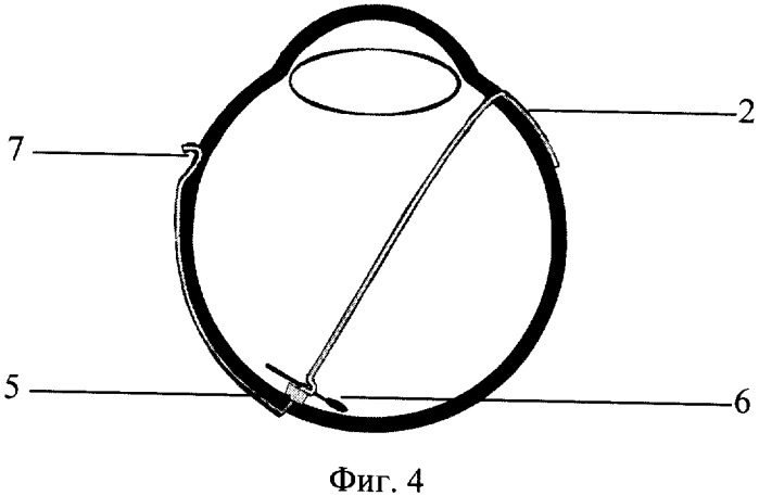 Способ проведения интраокулярной брахитерапии (патент 2325139)