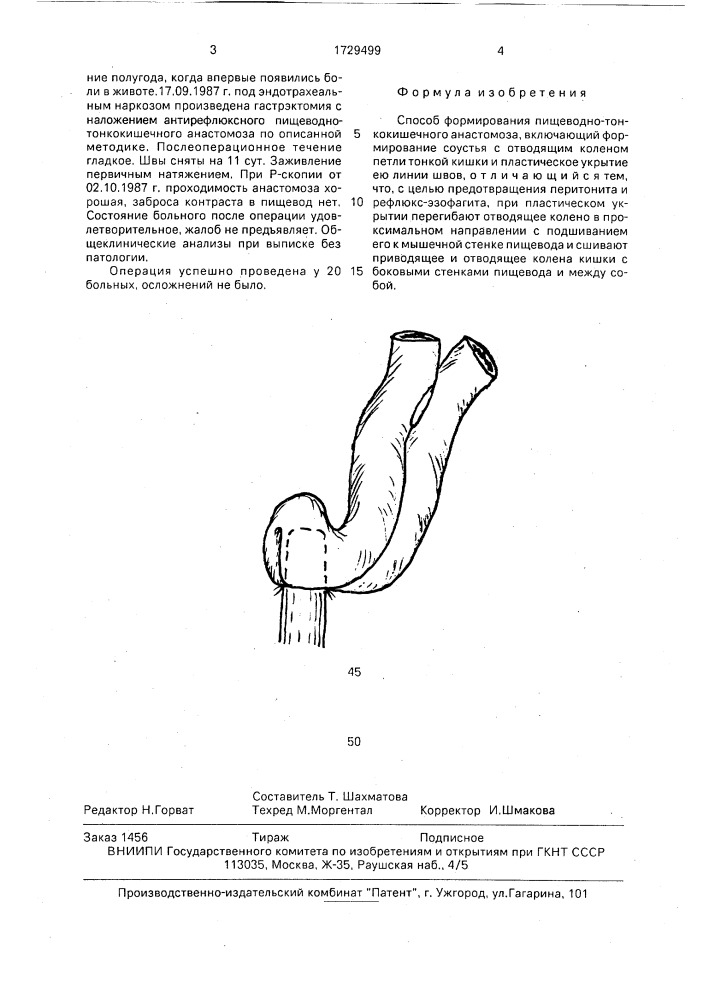 Способ формирования пищеводно-тонкокишечного анастомоза (патент 1729499)