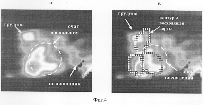 Способ топической диагностики воспалительных заболеваний сердца (патент 2244515)
