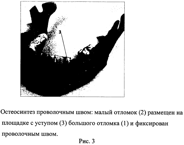 Способ костного шва для фиксации косых переломов нижней челюсти (патент 2565818)