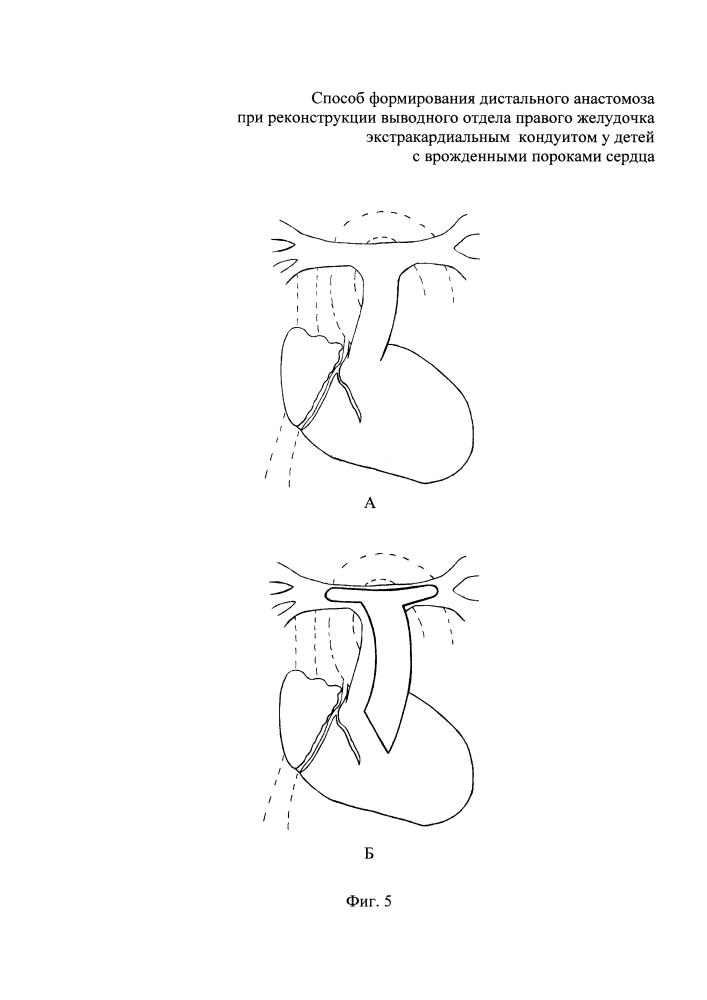 Способ формирования дистального анастомоза при реконструкции выводного отдела правого желудочка экстракардиальным кондуитом у детей с врожденными пороками сердца (патент 2644921)