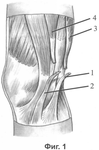Способ хирургического лечения застарелого разрыва передней крестообразной связки коленного сустава (патент 2347541)