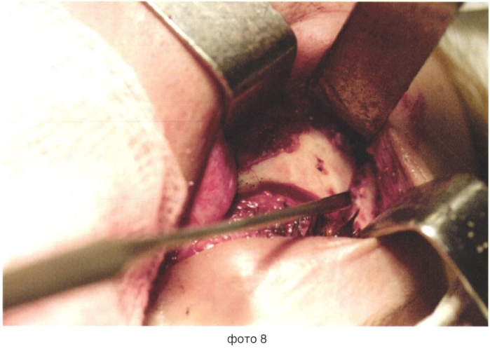 Способ обеспечения доступа при хирургическом лечении новообразований верхней челюсти (патент 2560662)