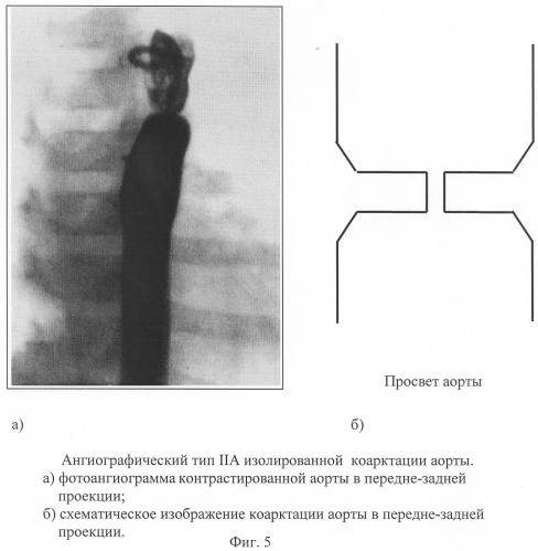 Способ диагностики изолированной коарктации аорты и способ выбора тактики ее лечения (патент 2244510)