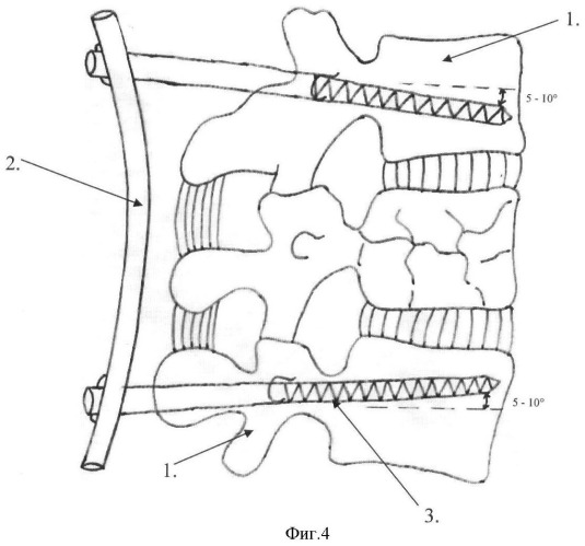 Способ коррекции травматического кифоза при взрывных переломах позвоночника у детей (патент 2364366)
