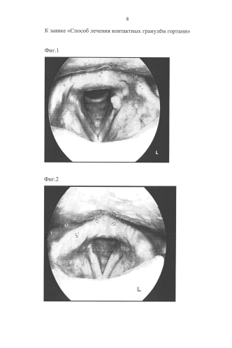 Способ лечения контактных гранулём гортани (патент 2591546)