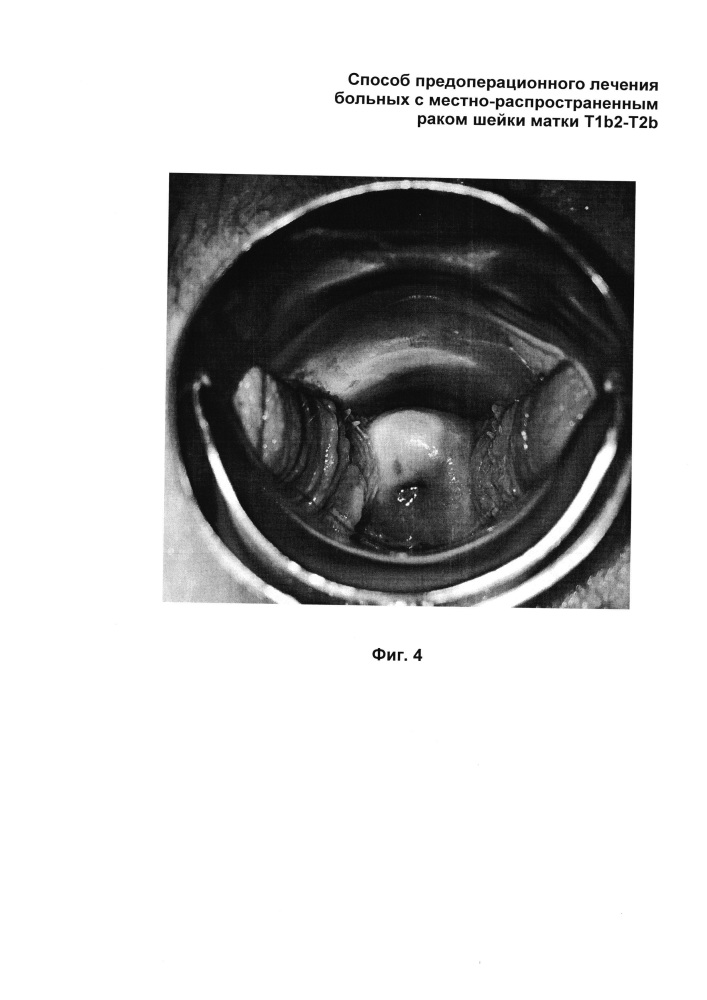 Способ предоперационного лечения больных с местно-распространенным раком шейки матки t1b2-t2b стадии (патент 2613888)