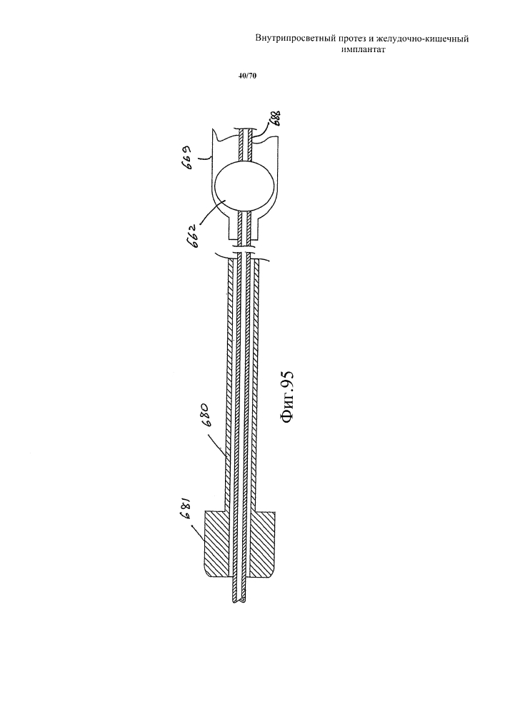 Внутрипросветный протез и желудочно-кишечный имплантат (патент 2626885)