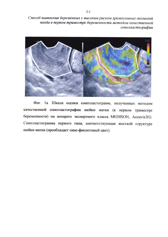 Способ отбора беременных женщин для проведения инвазивной диагностики хромосомных аномалий плода в первом триместре беременности методом качественной соноэластографии (патент 2626144)