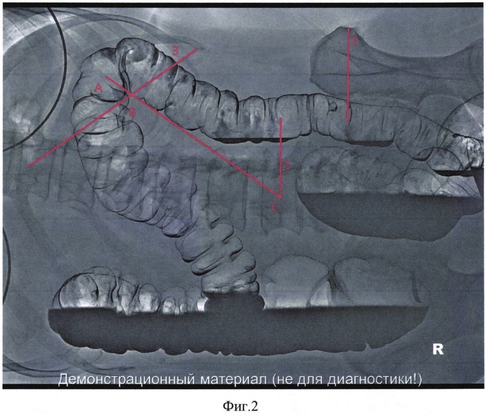 Способ диагностики и оценки смещения селезеночного изгиба и нисходящей ободочной кишки (патент 2626136)