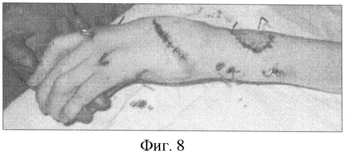 Способ лечения сгибательной контрактуры лучезапястного сустава от 90&#176; и более у больных с артрогрипозом (патент 2373885)