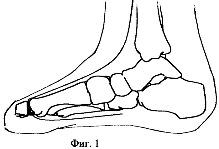 Способ восстановления первого пальца стопы при повреждениях и их последствиях (патент 2270628)