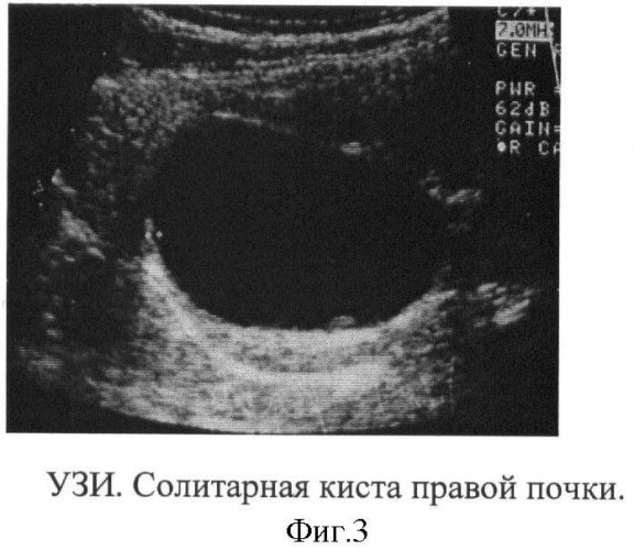 Способ дифференциальной диагностики чашечковых дивертикулов и солитарных кист почек у детей (патент 2411910)