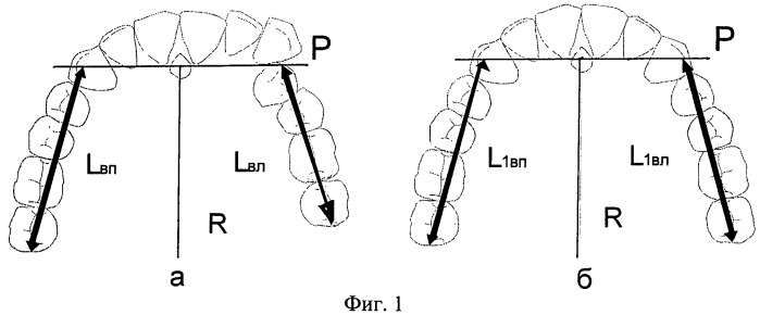 Способ биометрической диагностики направления и величины перемещения зубов при ортодонтическом лечении (патент 2436538)