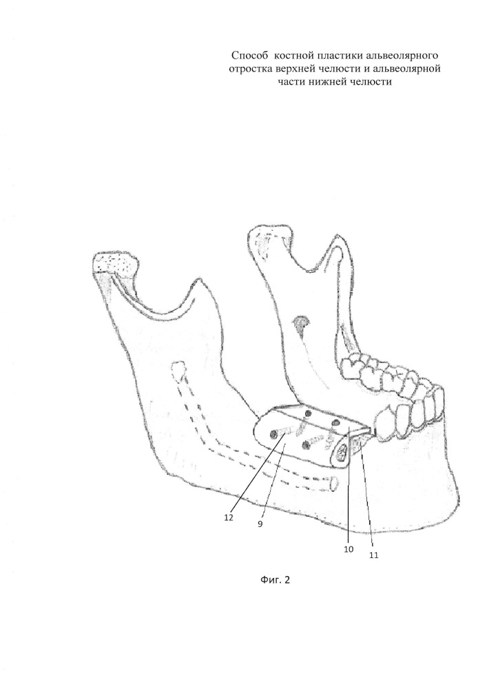 Способ костной пластики альвеолярного отростка верхней челюсти и альвеолярной части нижней челюсти (патент 2661039)