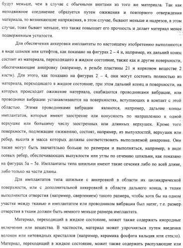 Имплантаты для создания соединений с тканями, в частности со скелетом, а также устройство и способ имплантации (патент 2314768)