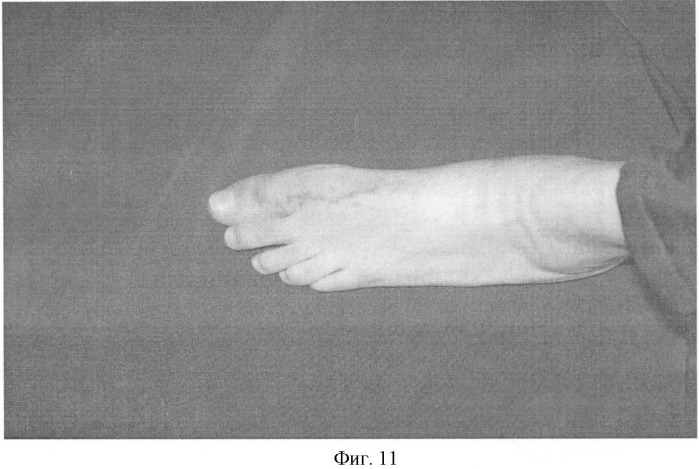 Способ лечения вальгусной деформации 1-го пальца стопы при детском церебральном параличе (патент 2489108)