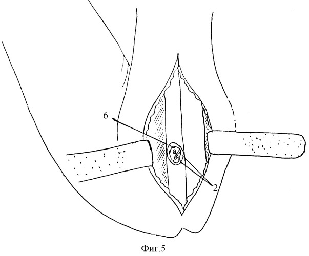 Способ лечения отрыва дистального сухожилия двуглавой мышцы плеча (патент 2300338)