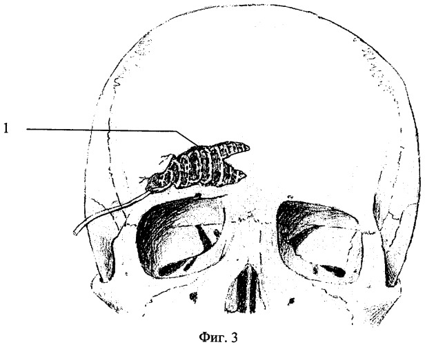 Способ лечения закрытых вдавленных переломов лицевой стенки лобных пазух (патент 2308245)