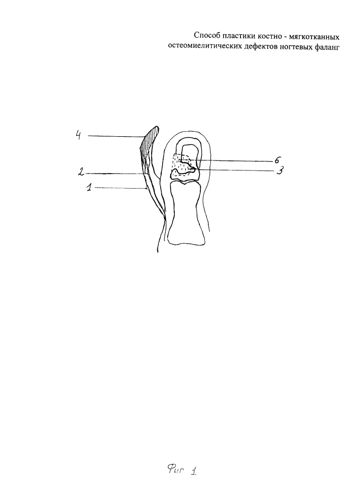 Способ пластики костно-мягкотканных остеомиелитических дефектов ногтевых фаланг (патент 2634421)