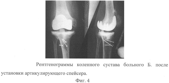 Способ лечения гнойного артрита, развившегося после тотального эндопротезирования коленного сустава (патент 2317022)