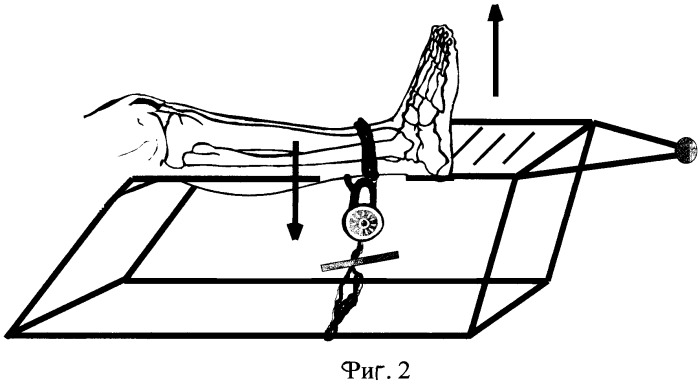 Способ рентгенодиагностики повреждения передней малоберцово-таранной связки голеностопного сустава (патент 2245677)