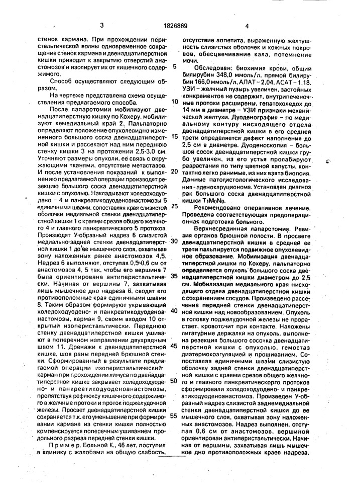 Способ лечения новообразований большого дуоденального соска (патент 1826869)