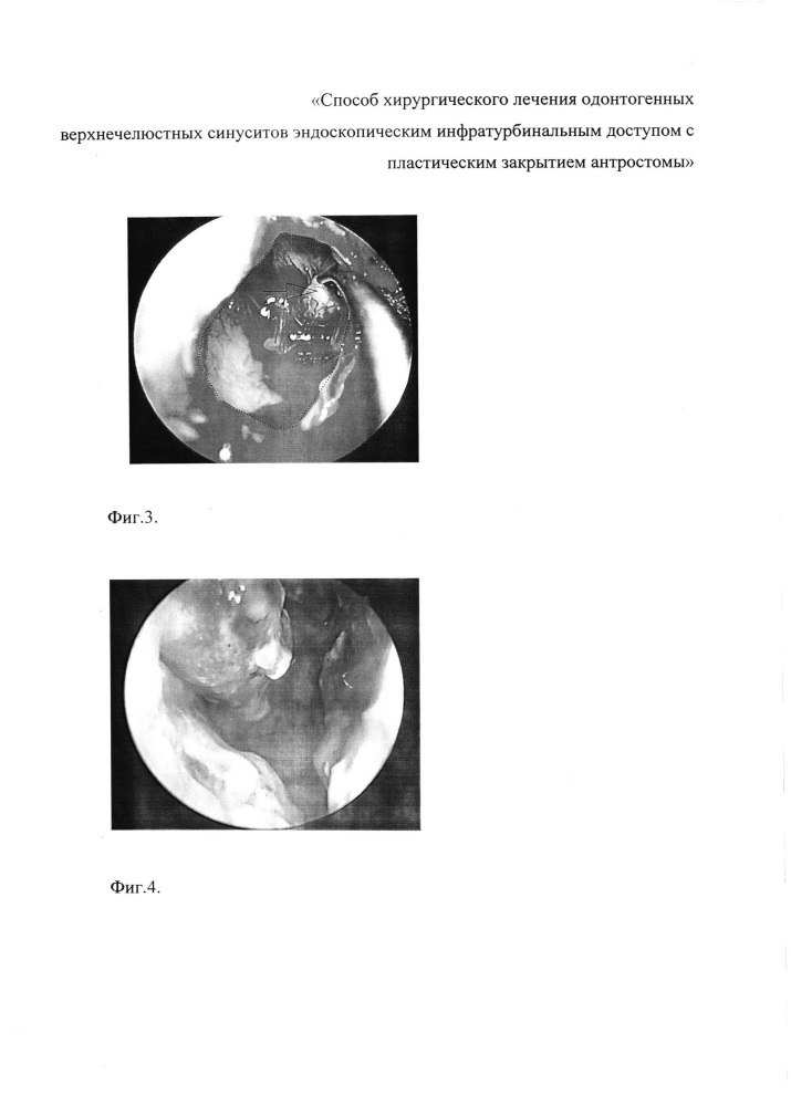 Способ хирургического лечения одонтогенных верхнечелюстных синуситов эндоскопическим инфратурбинальным доступом с пластическим закрытием антростомы (патент 2644697)