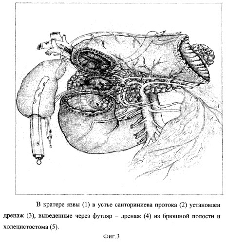 Способ хирургического лечения низкой околососочковой осложненной язвы двенадцатиперстной кишки с повреждением санториниева протока и стриктурой большого дуоденального сосочка (патент 2292847)