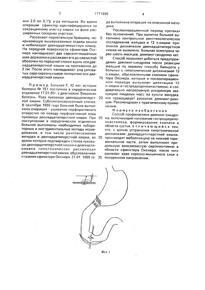 Способ профилактики демпинг-синдрома (патент 1771696)