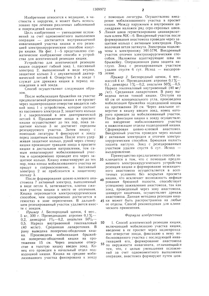 Способ асептической резекции кишки и устройство для его осуществления (патент 1309972)