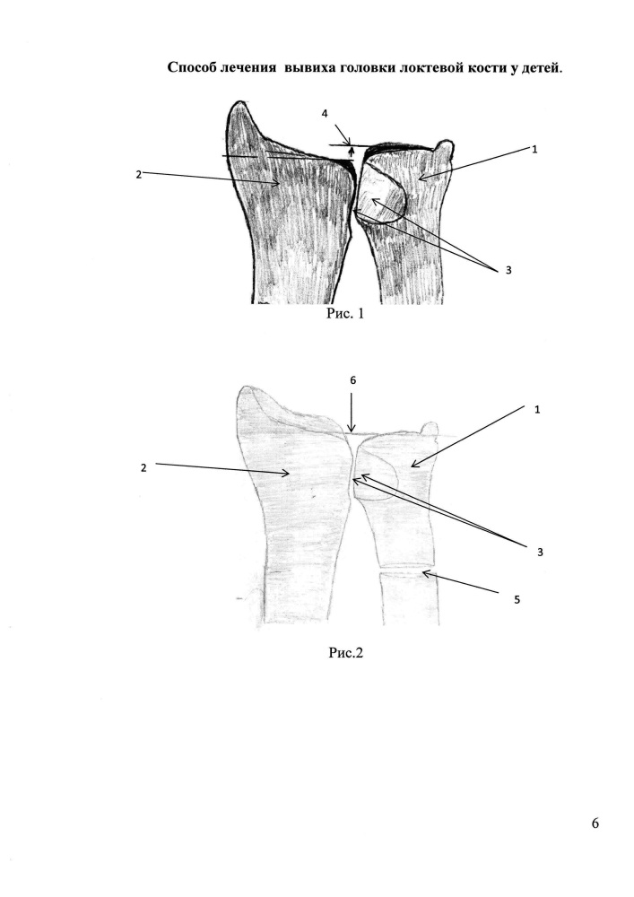 Способ лечения вывиха головки локтевой кости у детей (патент 2647178)