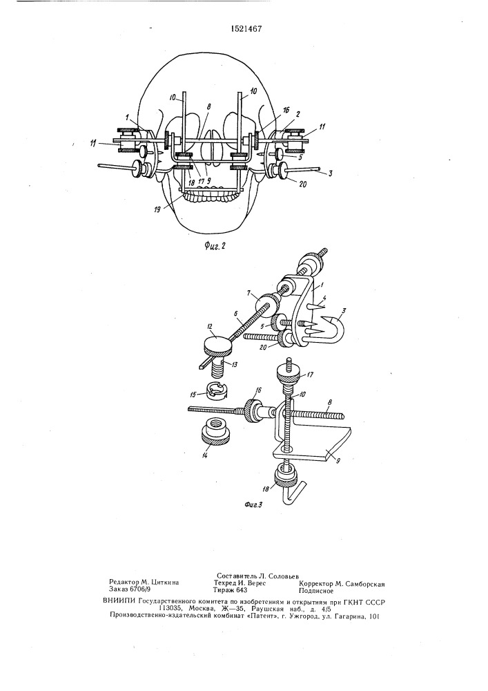 Устройство для лечения переломов и деформаций средней зоны лица (патент 1521467)