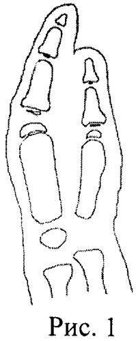 Способ лечения крайней формы брахидактилии (патент 2457802)
