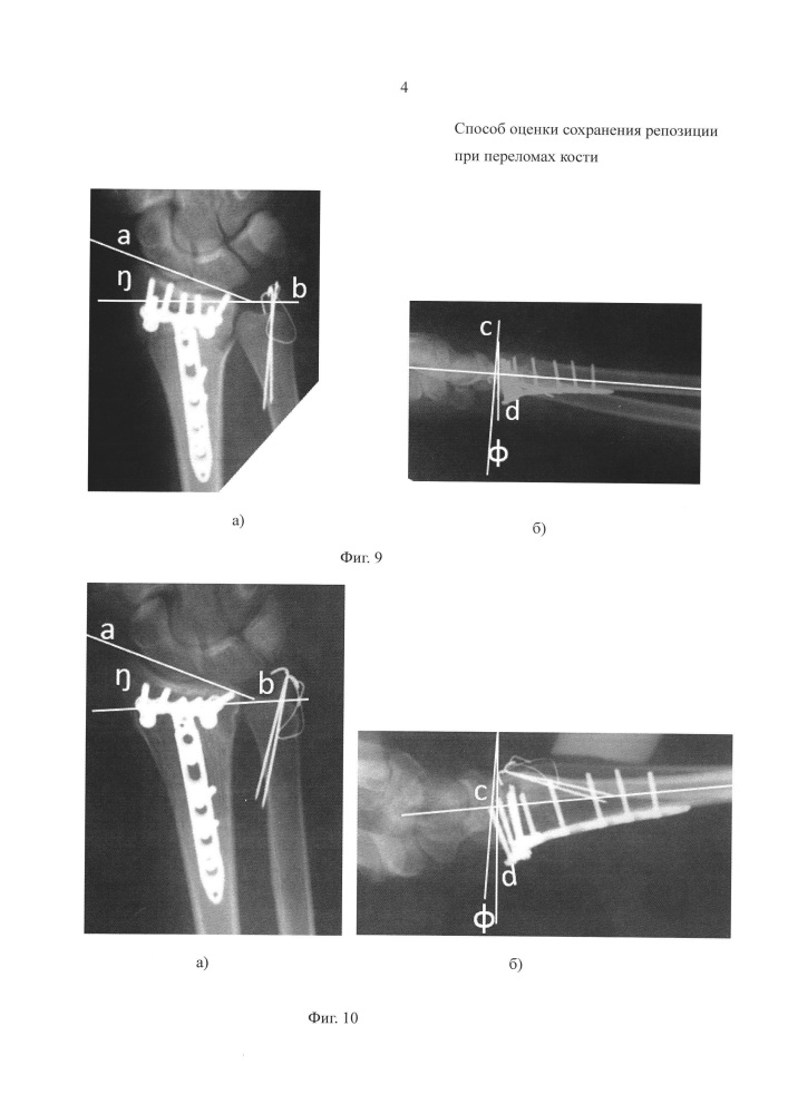 Способ оценки сохранения репозиции переломов костей (патент 2626375)