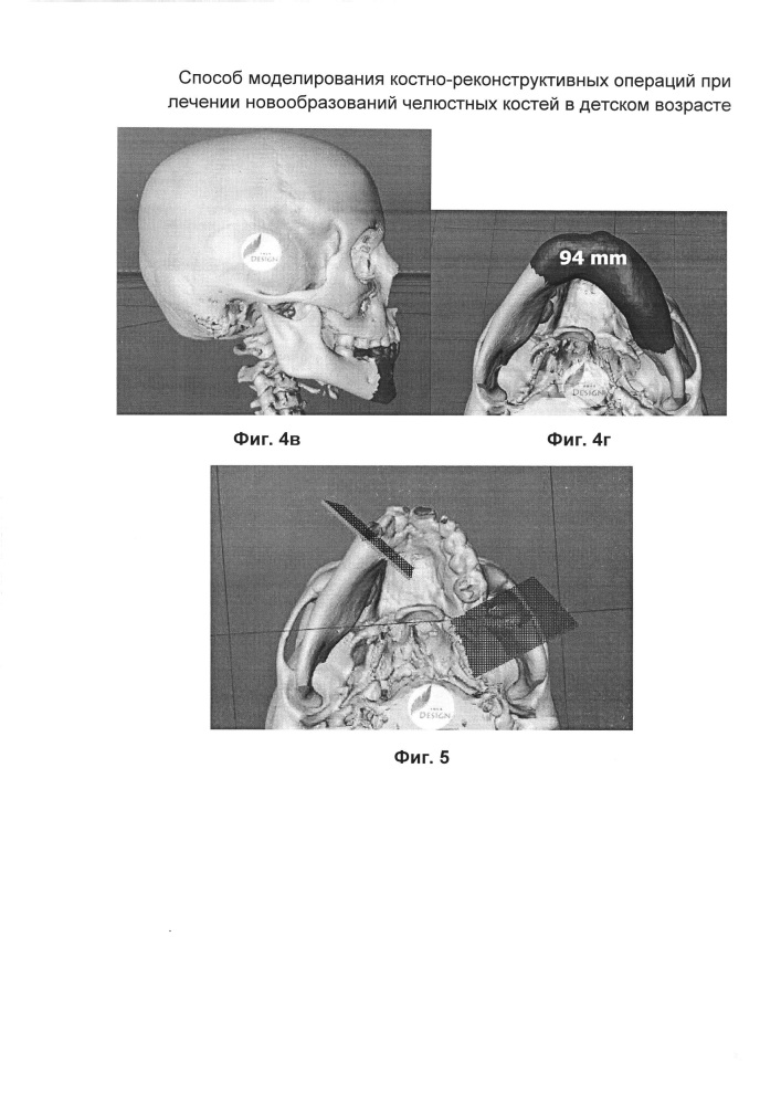 Способ моделирования костно-реконструктивных операций при лечении новообразований челюстных костей в детском возрасте (патент 2607651)