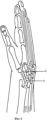 Способ устранения порочного положения кисти и пальцев при необратимых поражениях мышц предплечья (патент 2471441)