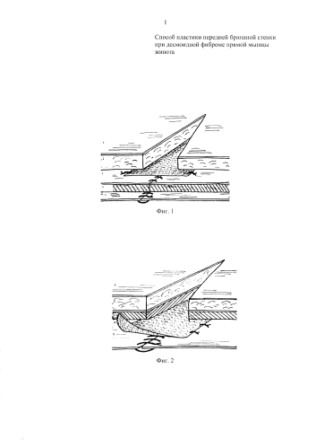 Способ пластики передней брюшной стенки при десмоидной фиброме прямой мышцы живота (патент 2581249)