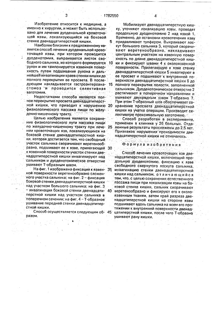 Способ лечения кровоточащих язв двенадцатиперстной кишки (патент 1782550)