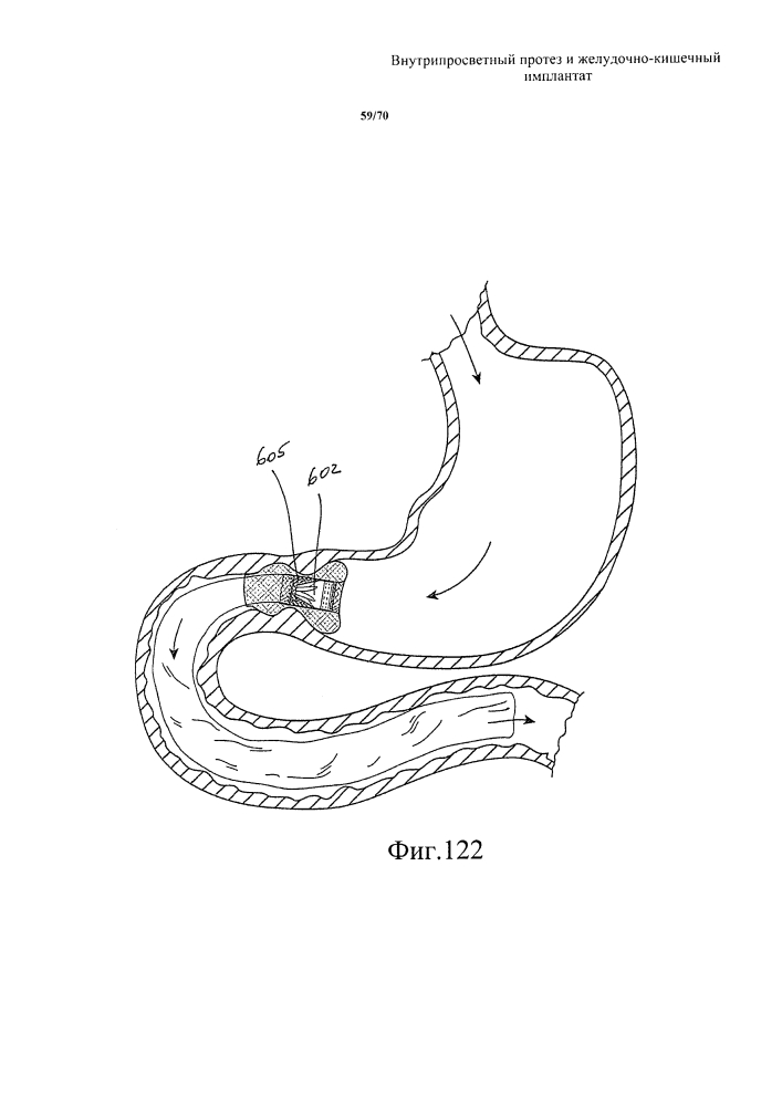 Внутрипросветный протез и желудочно-кишечный имплантат (патент 2626885)