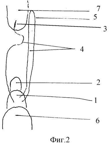 Шина для лечения переломов альвеолярного отростка верхней челюсти (патент 2290146)